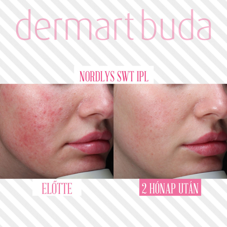 Rosacea kezelés